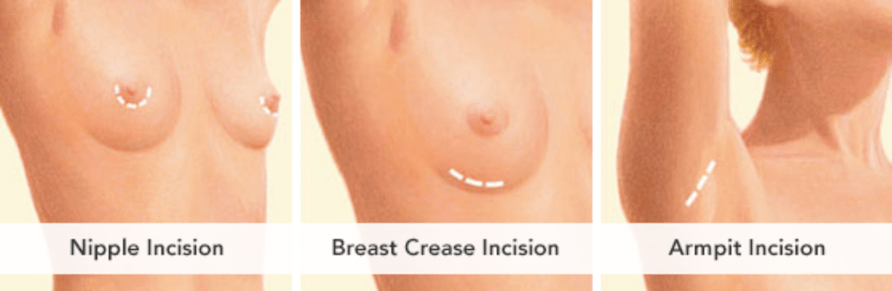 Breast Incision Options