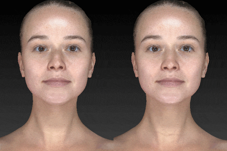 Vectra 3D Imaging Face