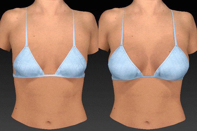 Vectra 3D Imaging Chest