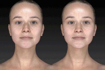 Vectra 3D Imaging Face