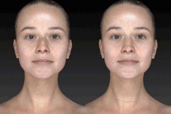 Vectra 3D Imaging Face