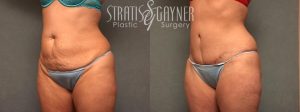 Oblique view of woman's midsection before and after a tummy tuck.