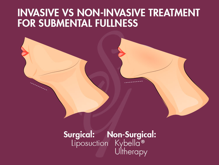 Invasive vs non-invasive treatment for submental fullness