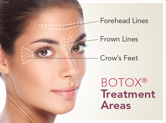 Botox Treatment Areas