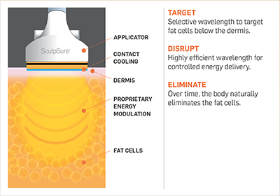 how SculpSure works