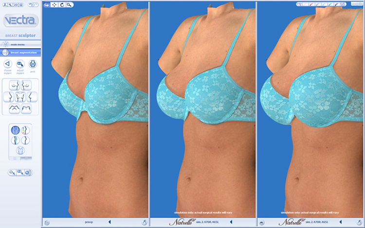 Vectra 3D imaging Breast Example