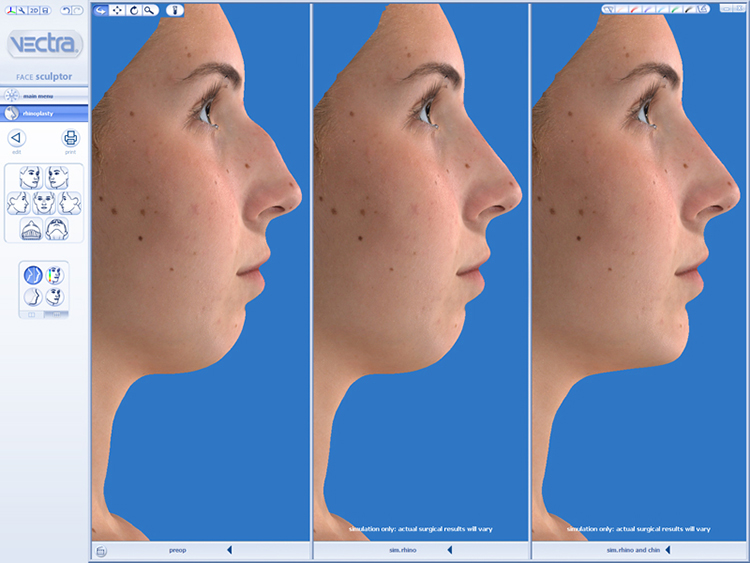 Vectra 3D Imaging Nose Example